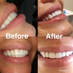 Teeth Whitening