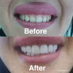 Veneers