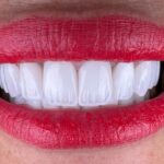 Veneers