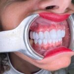 Veneers