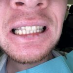 Teeth Whitening
