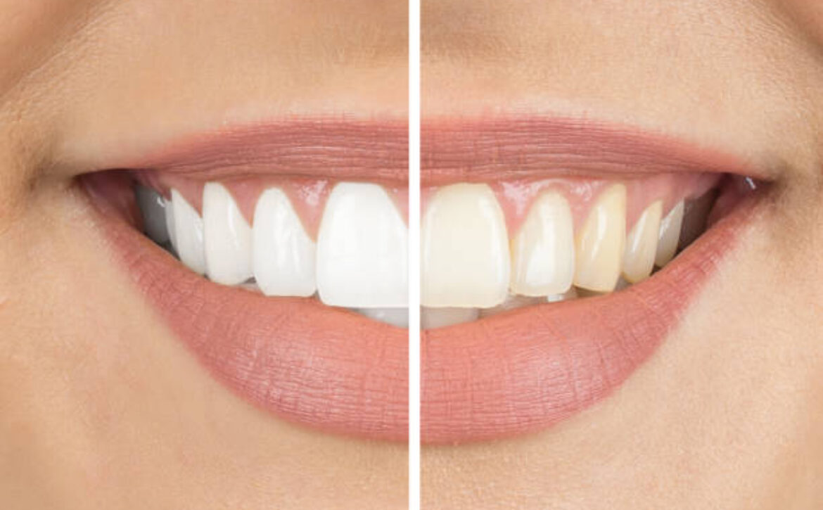 Before and after