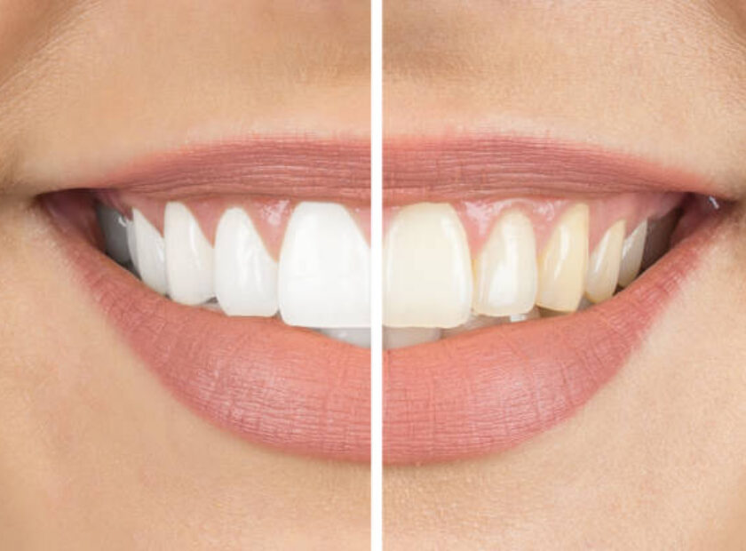 Before and after