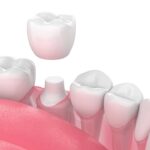 Understanding Dental Crowns in Dubai :When You Need Them 2024