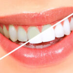 Teeth Whitening in Dubai 2024