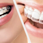 Understanding Orthodontics in Dubai 2024