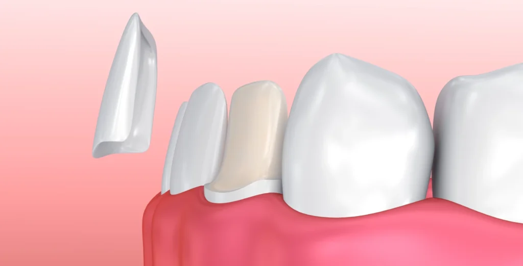 Dental Veneers