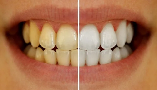 Dental clinic for teeth whitening
Dental clinic Abu Dhabi
Teeth whitening at MK Dent Clinic