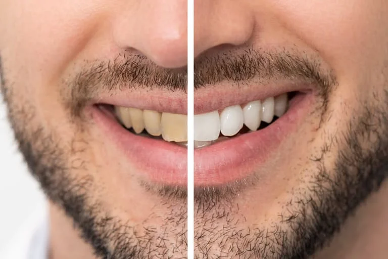 A bright, white smile can boost your confidence and make a lasting impression. If you're considering teeth whitening treatments, Teeth whitening at MK Dent Clinic in Abu Dhabi is an ideal option. Known for its high-quality dental services, MK Dent Clinic provides a professional approach to teeth whitening that promises lasting results. The clinic’s reputation as a trusted Dental clinic Abu Dhabi is built on years of experience and a dedication to patient care. If you're searching for affordable options, Low-price dental clinic near me, MK Dent Clinic offers competitive prices without sacrificing the quality of care