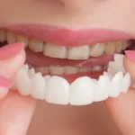 Dental Veneers in Dubai Price