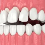 Types of Dental Veneers and Their Prices 2024